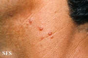 histiocytoma-generalized eruptive histiocytoma