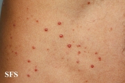 histiocytoma-generalized eruptive histiocytoma