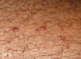 histiocytoma-generalized eruptive histiocytoma