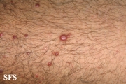 histiocytoma-generalized eruptive histiocytoma