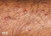 histiocytoma-generalized eruptive histiocytoma