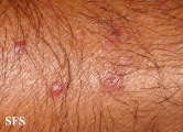 histiocytoma-generalized eruptive histiocytoma