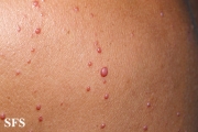 histiocytoma-generalized eruptive histiocytoma