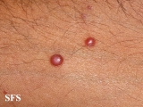 histiocytoma-generalized eruptive histiocytoma
