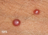 histiocytoma-generalized eruptive histiocytoma