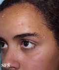 nevoid basal cell carcinoma syndrome