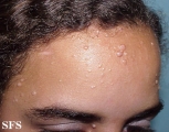 nevoid basal cell carcinoma syndrome