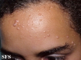 nevoid basal cell carcinoma syndrome