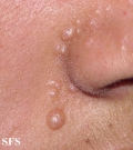 nevoid basal cell carcinoma syndrome
