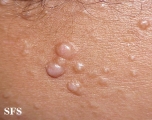 nevoid basal cell carcinoma syndrome
