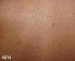 nevoid basal cell carcinoma syndrome