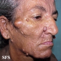 nevoid basal cell carcinoma syndrome