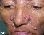 nevoid basal cell carcinoma syndrome