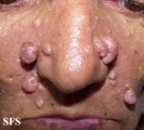 nevoid basal cell carcinoma syndrome