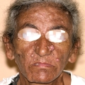 nevoid basal cell carcinoma syndrome