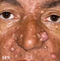 nevoid basal cell carcinoma syndrome