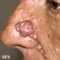 nevoid basal cell carcinoma syndrome