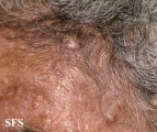 nevoid basal cell carcinoma syndrome