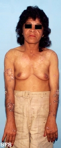 lupus erythematosus chronicus verrucous