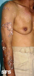 lupus erythematosus chronicus verrucous