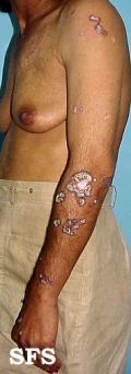 lupus erythematosus chronicus verrucous