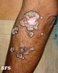 lupus erythematosus chronicus verrucous