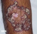 lupus erythematosus chronicus verrucous