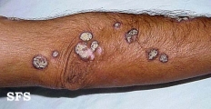 lupus erythematosus chronicus verrucous