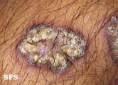 lupus erythematosus chronicus verrucous