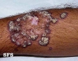 lupus erythematosus chronicus verrucous