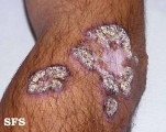 lupus erythematosus chronicus verrucous
