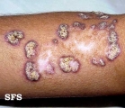 lupus erythematosus chronicus verrucous