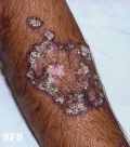 lupus erythematosus chronicus verrucous