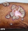 lupus erythematosus chronicus verrucous