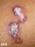 lupus erythematosus chronicus verrucous