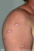 lupus erythematosus chronicus verrucous