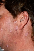 lupus erythematosus chronicus verrucous