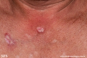 lupus erythematosus chronicus verrucous