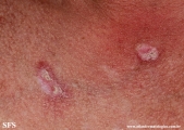 lupus erythematosus chronicus verrucous