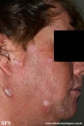 lupus erythematosus chronicus verrucous