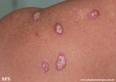 lupus erythematosus chronicus verrucous