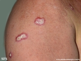 lupus erythematosus chronicus verrucous