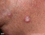 lupus erythematosus chronicus verrucous