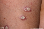 lupus erythematosus chronicus verrucous