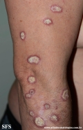 lupus erythematosus chronicus verrucous