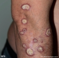 lupus erythematosus chronicus verrucous