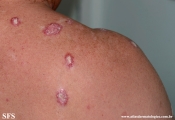 lupus erythematosus chronicus verrucous