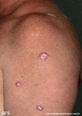 lupus erythematosus chronicus verrucous