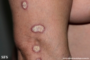 lupus erythematosus chronicus verrucous