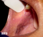 lichen planus of the mucosa